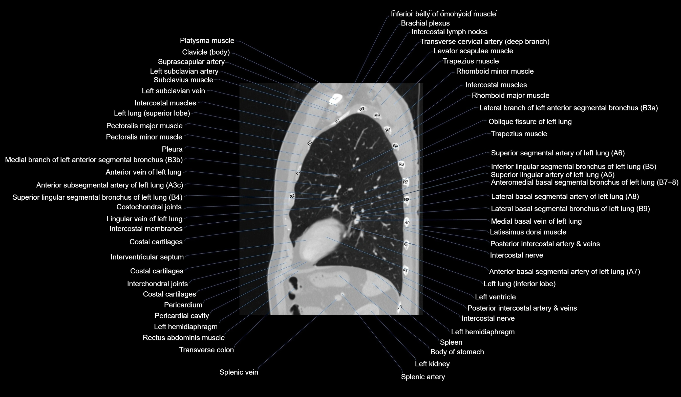 CT chest (thorax) labelled sagittal cross sectional anatomy radiology image-00102.webp